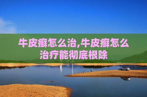 牛皮癣怎么治,牛皮癣怎么治疗能彻底根除
