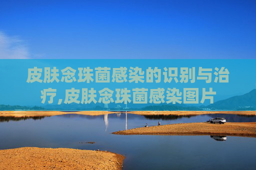 皮肤念珠菌感染的识别与治疗,皮肤念珠菌感染图片