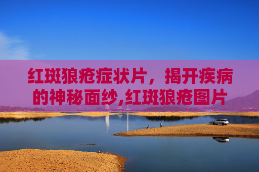 红斑狼疮症状片，揭开疾病的神秘面纱,红斑狼疮图片用药大全