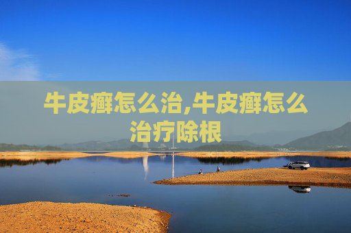 牛皮癣怎么治,牛皮癣怎么治疗除根